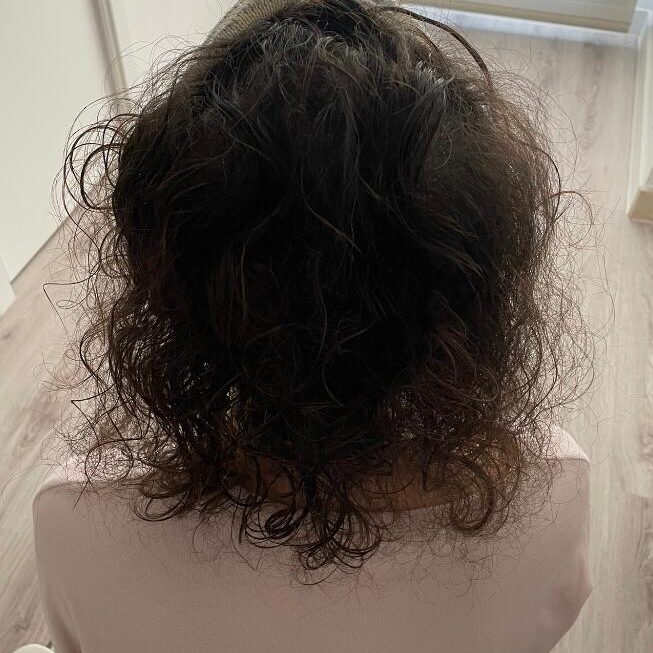 Resultados excelentes en María C. con tratamiento con máquina de gorro frío de Anuel tras su quimioterapia.